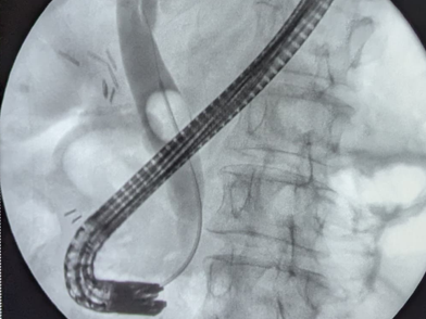Операция при желчнокаменной болезни  Операция при желчнокаменной болезни