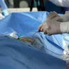 Без разрезов и наркоза: хирурги ВолгГМУ освоили новый метод удаления тромбов