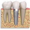 dental-implants-straumann2. Источник: http://www.maxiladental.com/wp-content/uploads/2011/03/dental-implants-straumann2.jpg