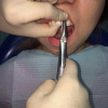 Операция удаления зуба