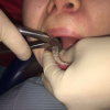 Операция удаления зуба